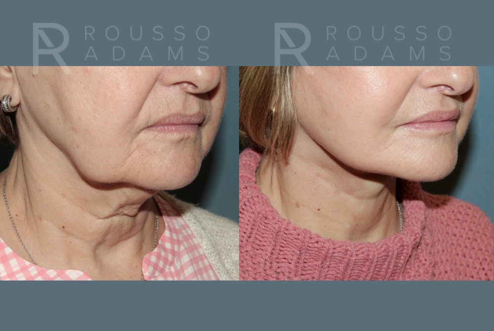 Deep Plane Facelift Before & After Gallery - Patient 406952 - Image 4