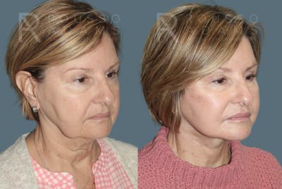 Deep Plane Facelift Before & After Gallery - Patient 406952 - Image 1