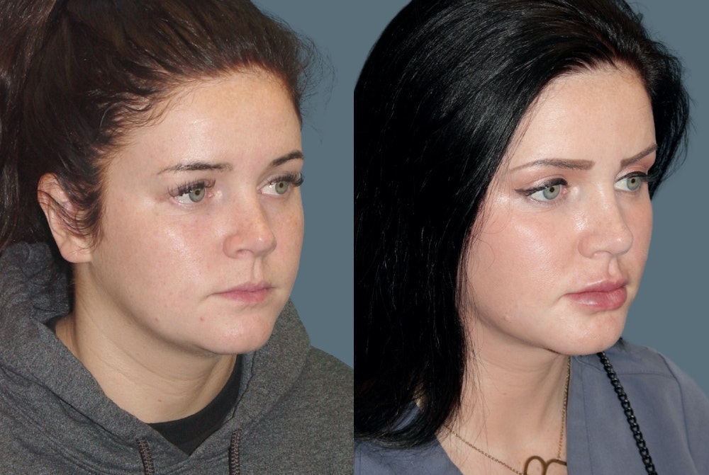 Acculift <span class=small>By Dr. Austin Adams</span> Before & After Gallery - Patient 261431 - Image 1