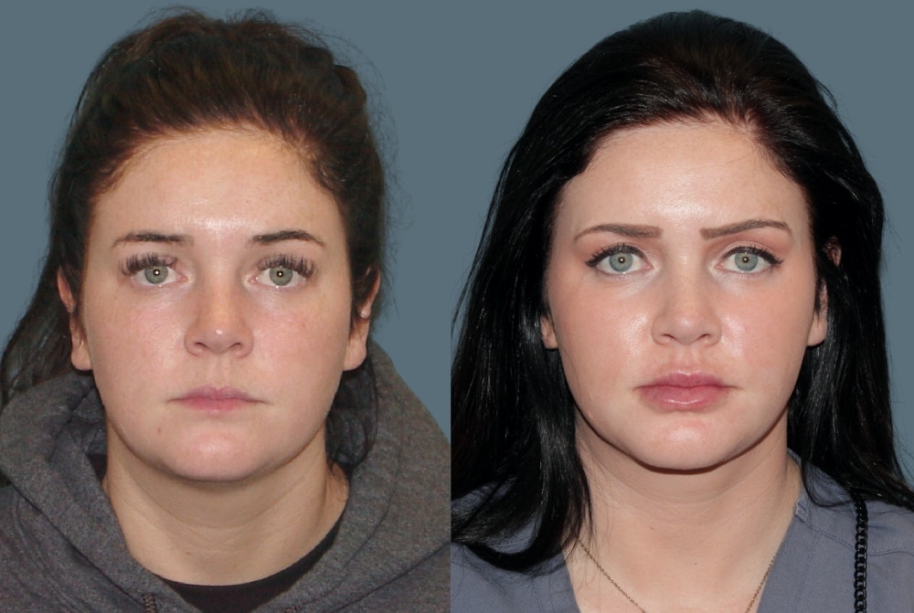 Acculift <span class=small>By Dr. Austin Adams</span> Before & After Gallery - Patient 261431 - Image 2