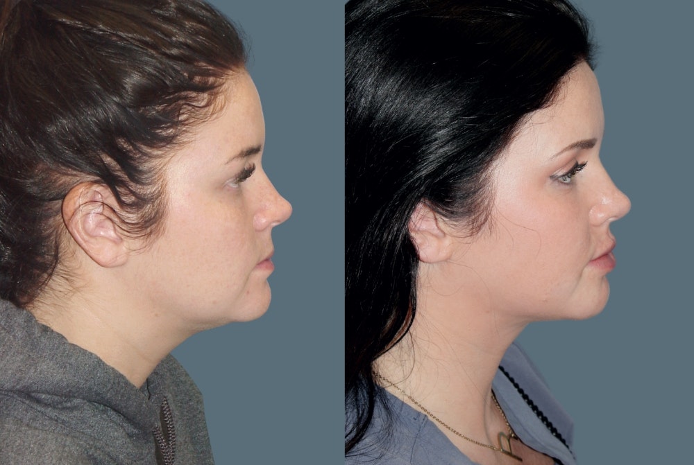 Acculift <span class=small>By Dr. Austin Adams</span> Before & After Gallery - Patient 261431 - Image 3