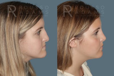 Rhinoplasty <span class=small>By Dr. Daniel Rousso</span> Before & After Gallery - Patient 975110 - Image 1