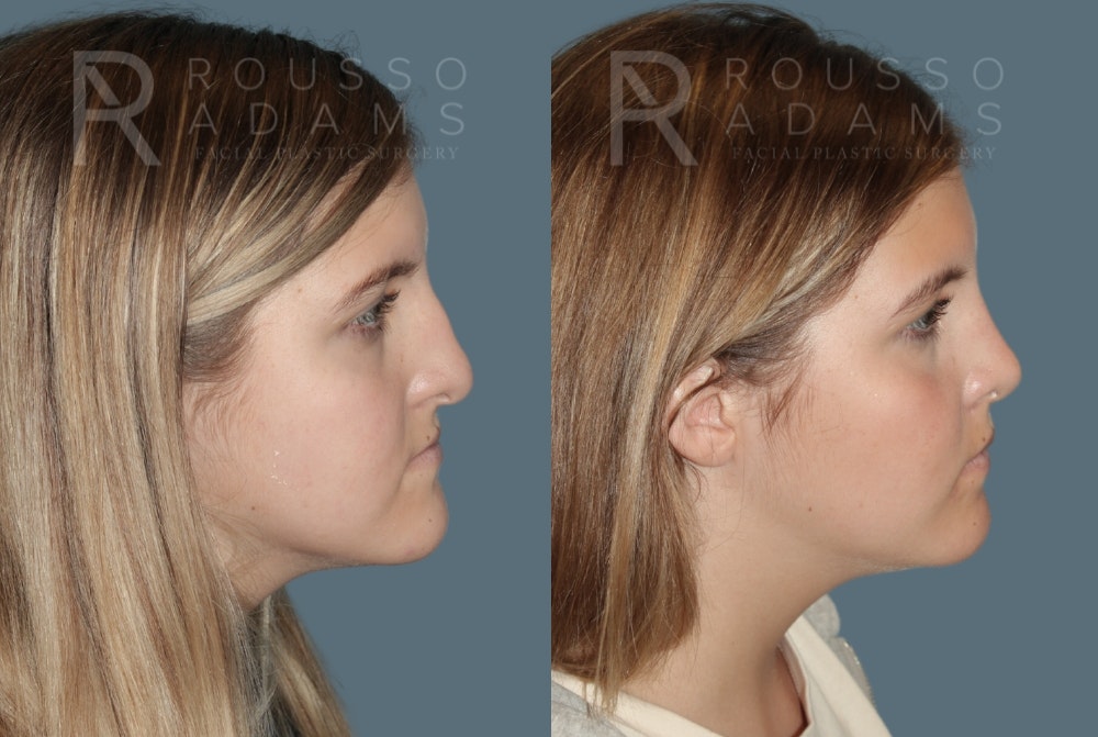 Rhinoplasty <span class=small>By Dr. Daniel Rousso</span> Before & After Gallery - Patient 975110 - Image 1