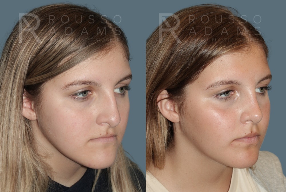 Rhinoplasty <span class=small>By Dr. Daniel Rousso</span> Before & After Gallery - Patient 975110 - Image 2