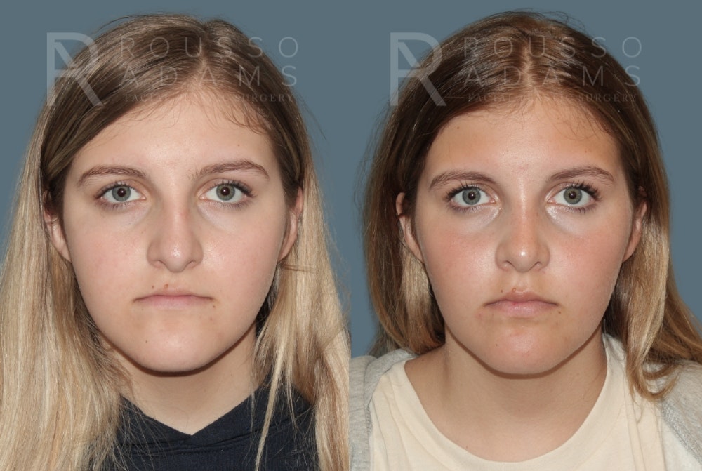 Rhinoplasty <span class=small>By Dr. Daniel Rousso</span> Before & After Gallery - Patient 975110 - Image 3