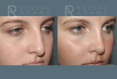 Rhinoplasty <span class=small>By Dr. Daniel Rousso</span> Before & After Gallery - Patient 975110 - Image 4