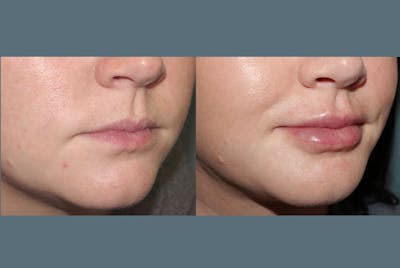Fillers Gallery Before & After Gallery - Patient 337576 - Image 2