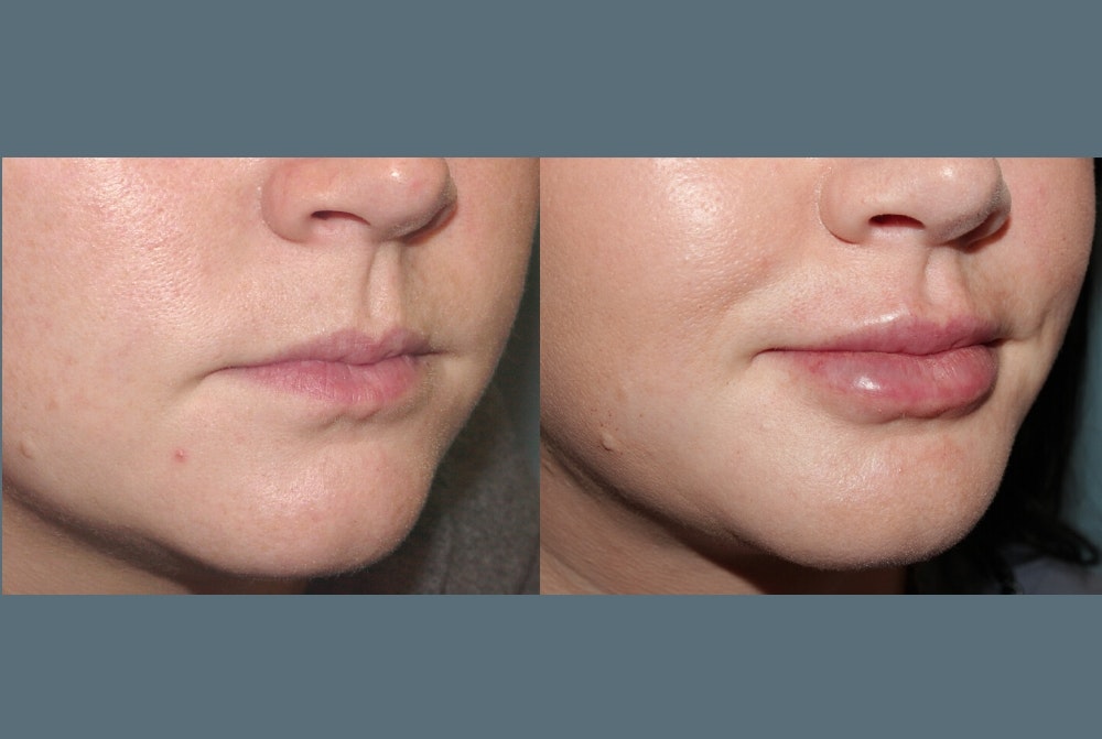 Fillers Before & After Gallery - Patient 337576 - Image 2