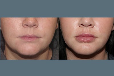 Fillers Gallery Before & After Gallery - Patient 337576 - Image 1