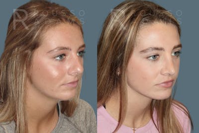Rhinoplasty<span class=small>By Dr. Austin Adams</span> Before & After Gallery - Patient 189749 - Image 2