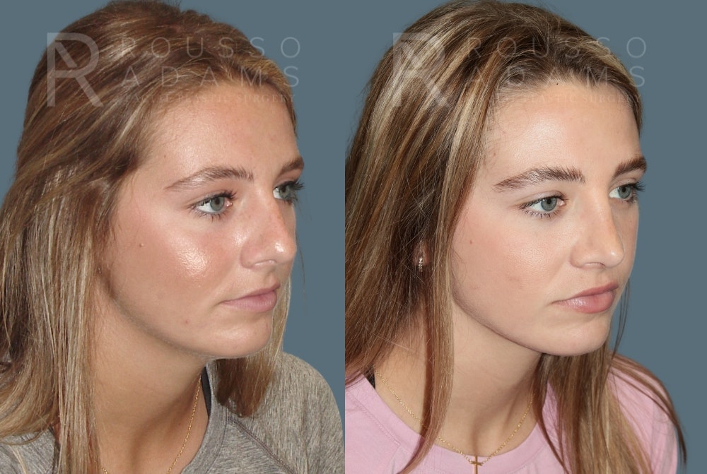Rhinoplasty Before & After Gallery - Patient 189749 - Image 2