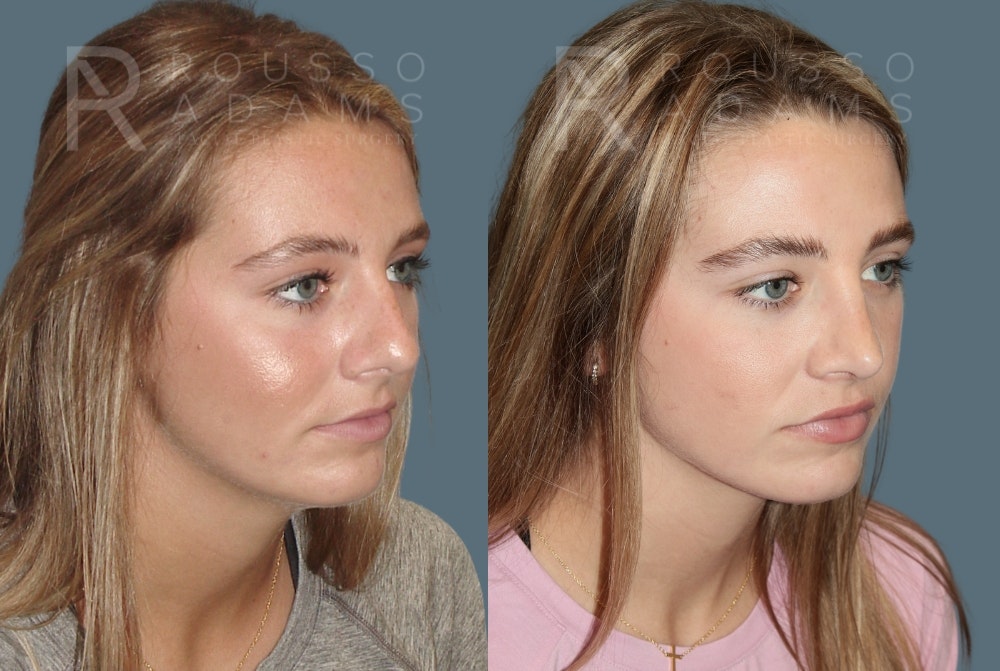 Rhinoplasty<span class=small>By Dr. Austin Adams</span> Before & After Gallery - Patient 189749 - Image 2