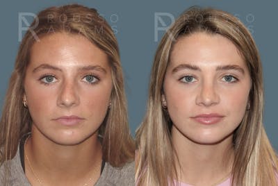 Rhinoplasty<span class=small>By Dr. Austin Adams</span> Before & After Gallery - Patient 189749 - Image 4