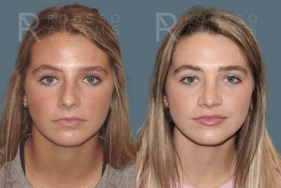 Rhinoplasty Before & After Gallery - Patient 189749 - Image 4