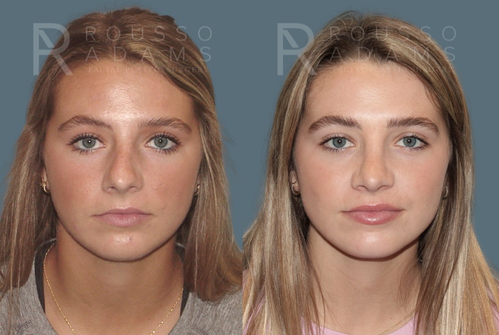 Rhinoplasty Before & After Gallery - Patient 189749 - Image 4