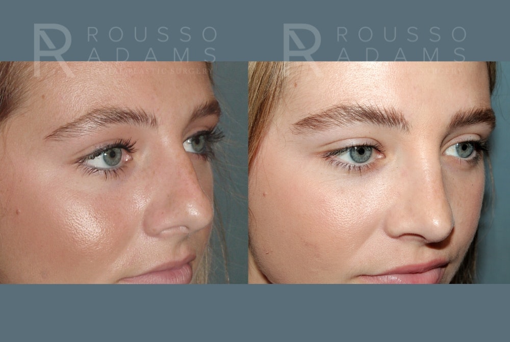 Rhinoplasty<span class=small>By Dr. Austin Adams</span> Before & After Gallery - Patient 189749 - Image 3