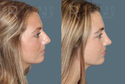 Rhinoplasty Before & After Gallery - Patient 189749 - Image 1