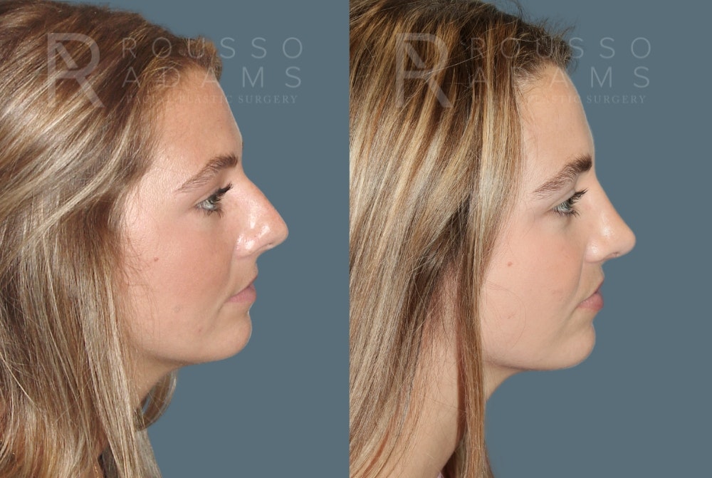 Rhinoplasty Before & After Gallery - Patient 189749 - Image 1