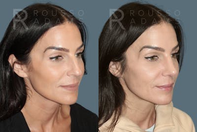 Rhinoplasty<span class=small>By Dr. Austin Adams</span> Before & After Gallery - Patient 378030 - Image 2
