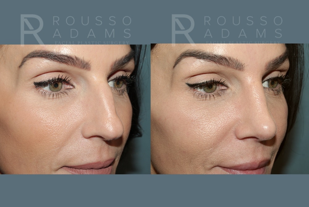 Rhinoplasty<span class=small>By Dr. Austin Adams</span> Before & After Gallery - Patient 378030 - Image 3