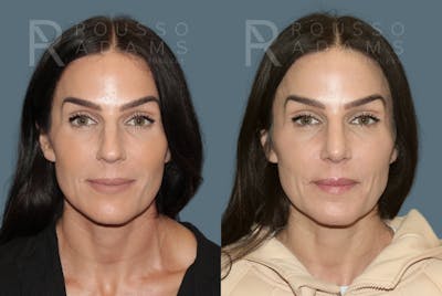 Rhinoplasty Before & After Gallery - Patient 378030 - Image 4