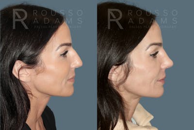 Rhinoplasty Before & After Gallery - Patient 378030 - Image 1