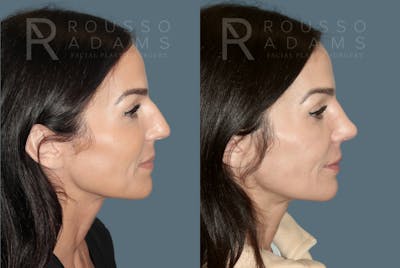 Rhinoplasty<span class=small>By Dr. Austin Adams</span> Before & After Gallery - Patient 378030 - Image 1