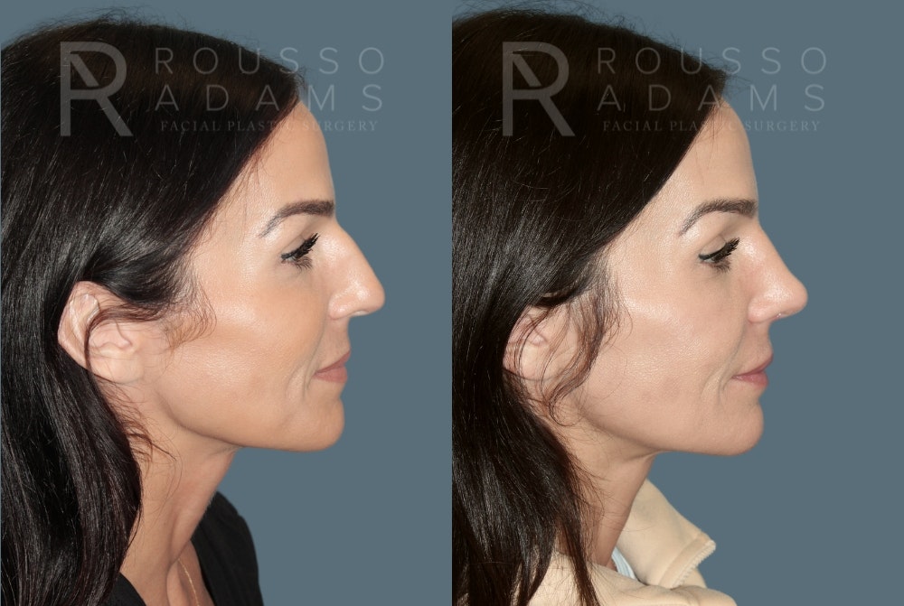 Rhinoplasty<span class=small>By Dr. Austin Adams</span> Before & After Gallery - Patient 378030 - Image 1