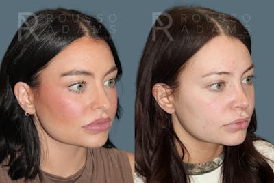 Rhinoplasty Before & After Gallery - Patient 607063 - Image 2