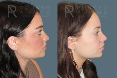 Rhinoplasty<span class=small>By Dr. Austin Adams</span> Before & After Gallery - Patient 607063 - Image 1