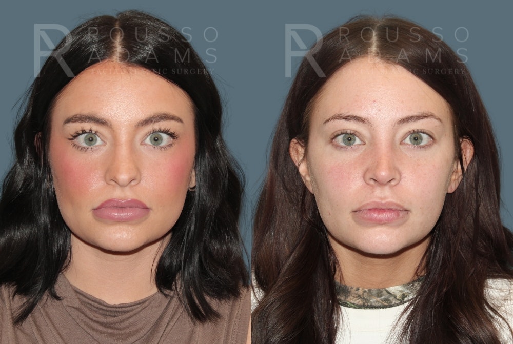 Rhinoplasty Before & After Gallery - Patient 607063 - Image 3