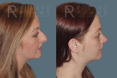Rhinoplasty <span class=small>By Dr. Daniel Rousso</span> Before & After Gallery - Patient 235742 - Image 1
