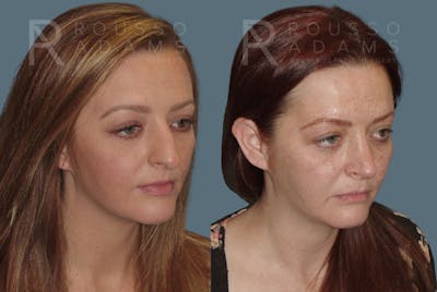 Rhinoplasty <span class=small>By Dr. Daniel Rousso</span> Before & After Gallery - Patient 235742 - Image 2