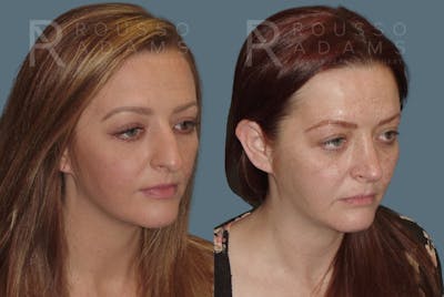 Rhinoplasty Before & After Gallery - Patient 235742 - Image 2