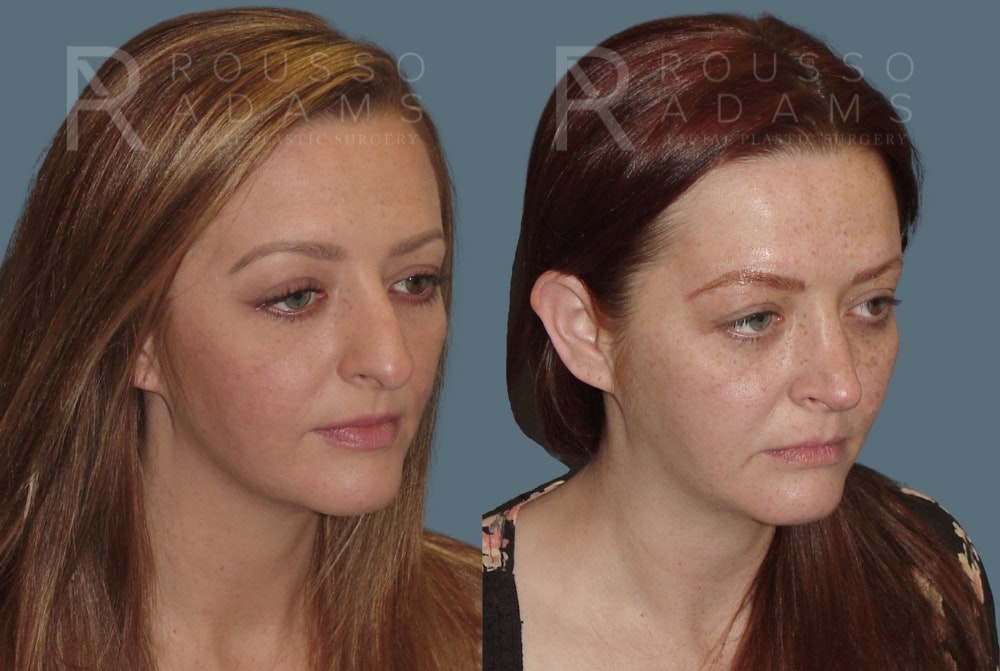 Rhinoplasty <span class=small>By Dr. Daniel Rousso</span> Before & After Gallery - Patient 235742 - Image 2