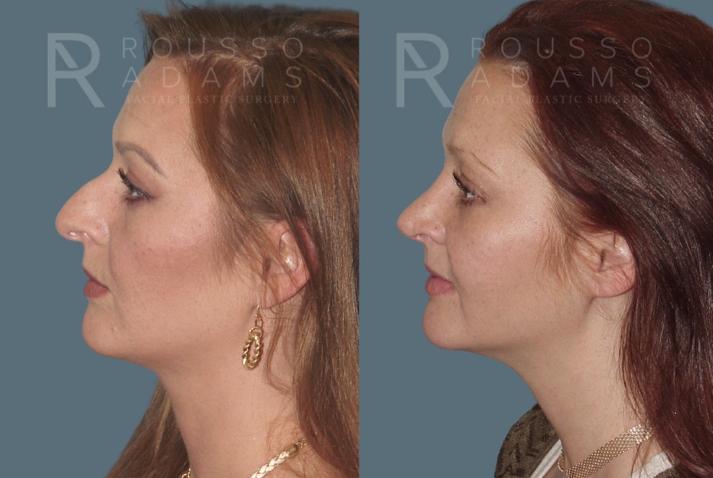 Rhinoplasty <span class=small>By Dr. Daniel Rousso</span> Before & After Gallery - Patient 235742 - Image 3