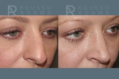 Rhinoplasty <span class=small>By Dr. Daniel Rousso</span> Before & After Gallery - Patient 235742 - Image 4