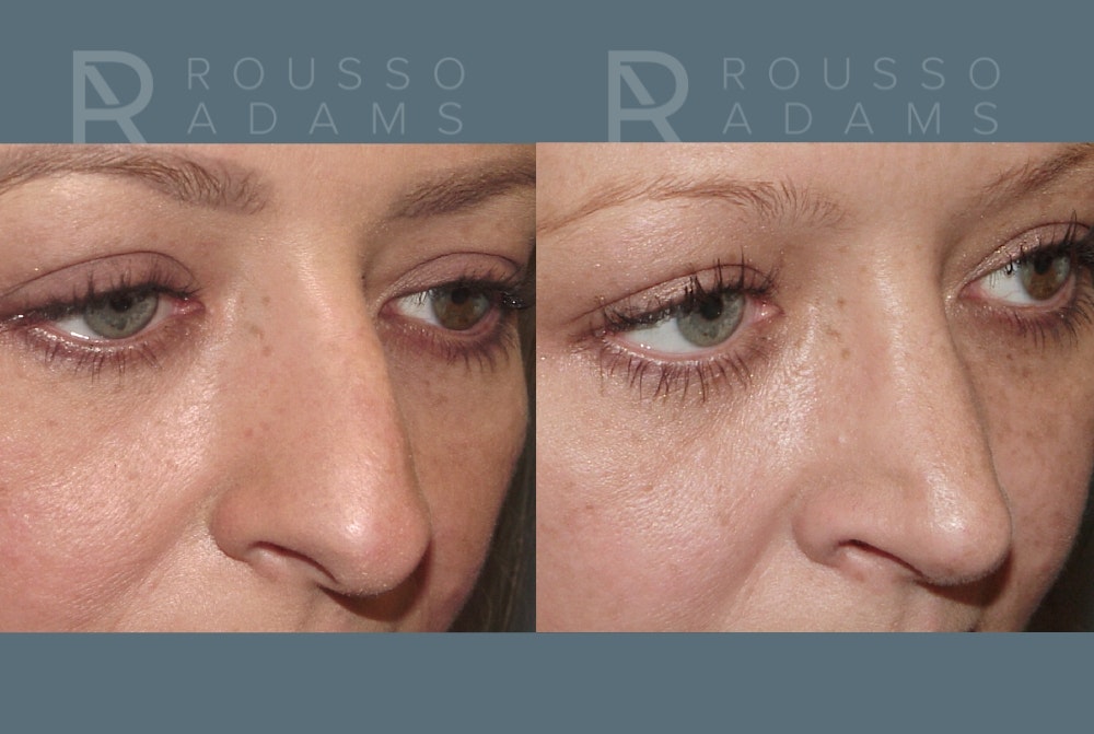 Rhinoplasty <span class=small>By Dr. Daniel Rousso</span> Before & After Gallery - Patient 235742 - Image 4