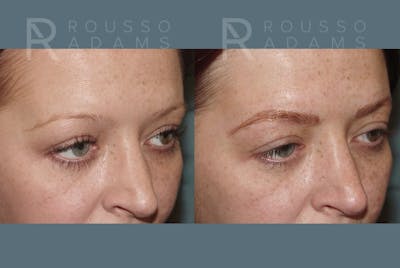 Microblading Before & After Gallery - Patient 967368 - Image 1
