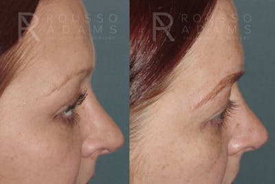 Microblading Before & After Gallery - Patient 967368 - Image 2