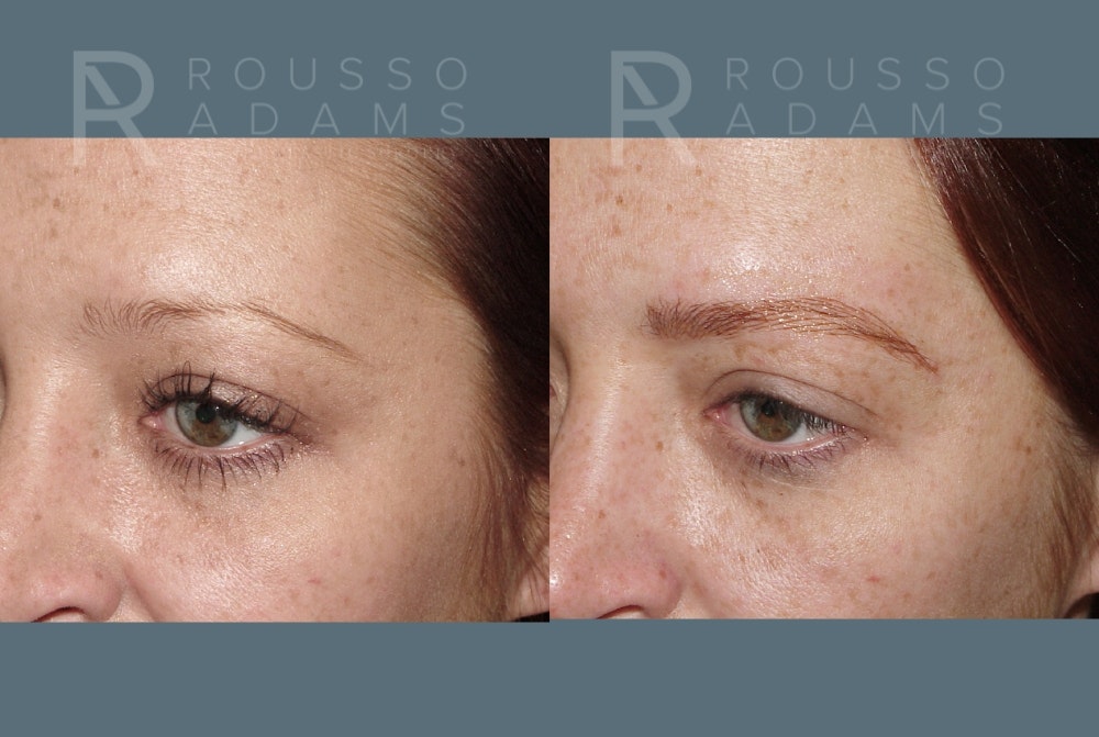 Microblading Before & After Gallery - Patient 967368 - Image 3