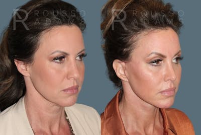 Deep Plane Facelift Before & After Gallery - Patient 422353 - Image 1