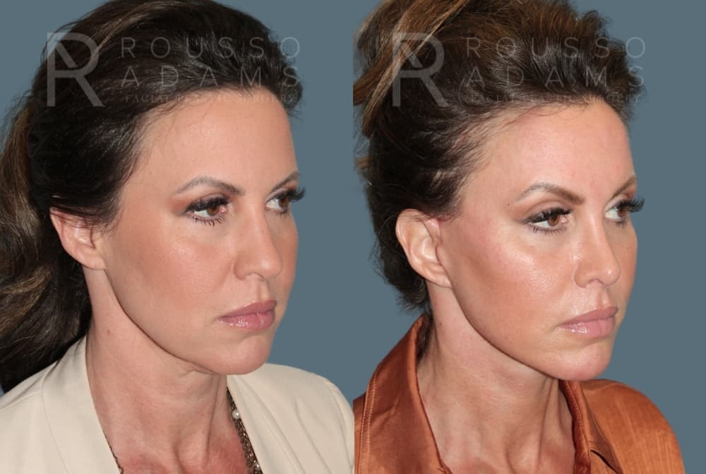 Deep Plane Facelift Before & After Gallery - Patient 422353 - Image 1