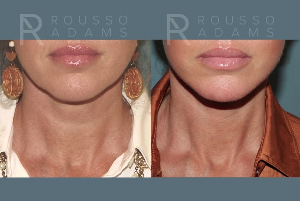 Deep Plane Facelift Before & After Gallery - Patient 422353 - Image 5