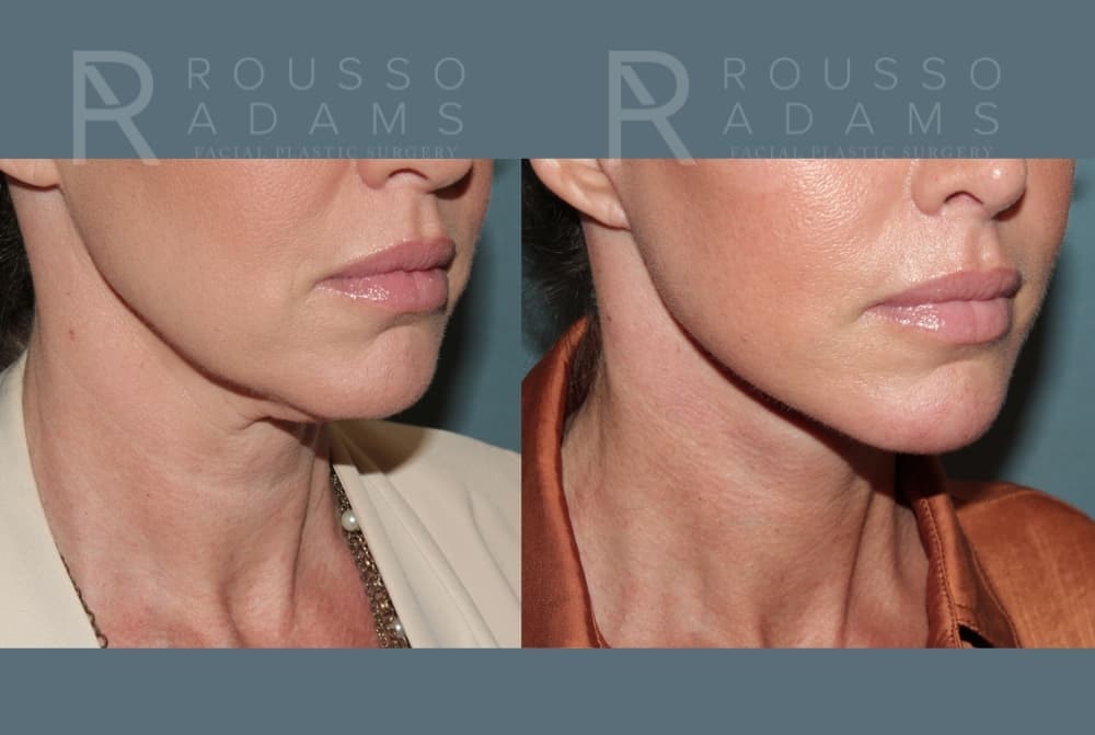Deep Plane Facelift Before & After Gallery - Patient 422353 - Image 6
