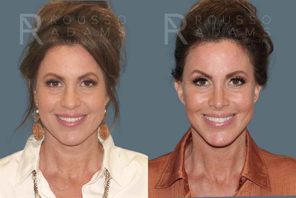 Deep Plane Facelift Before & After Gallery - Patient 422353 - Image 3