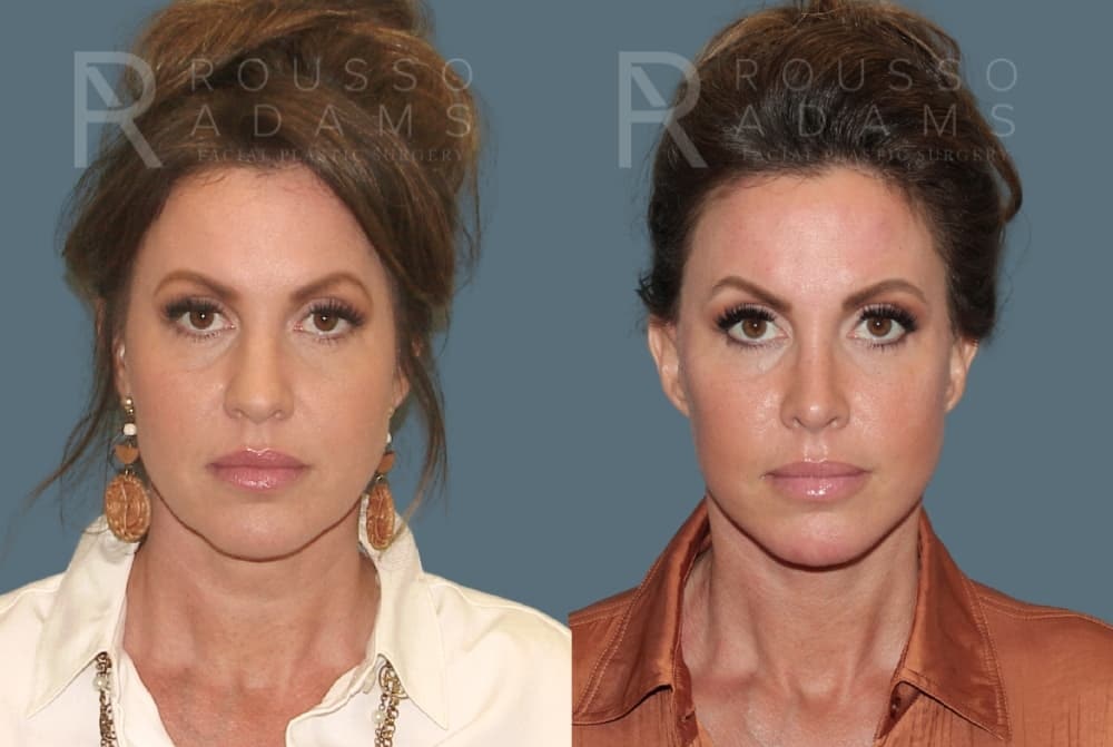 Deep Plane Facelift Before & After Gallery - Patient 422353 - Image 2
