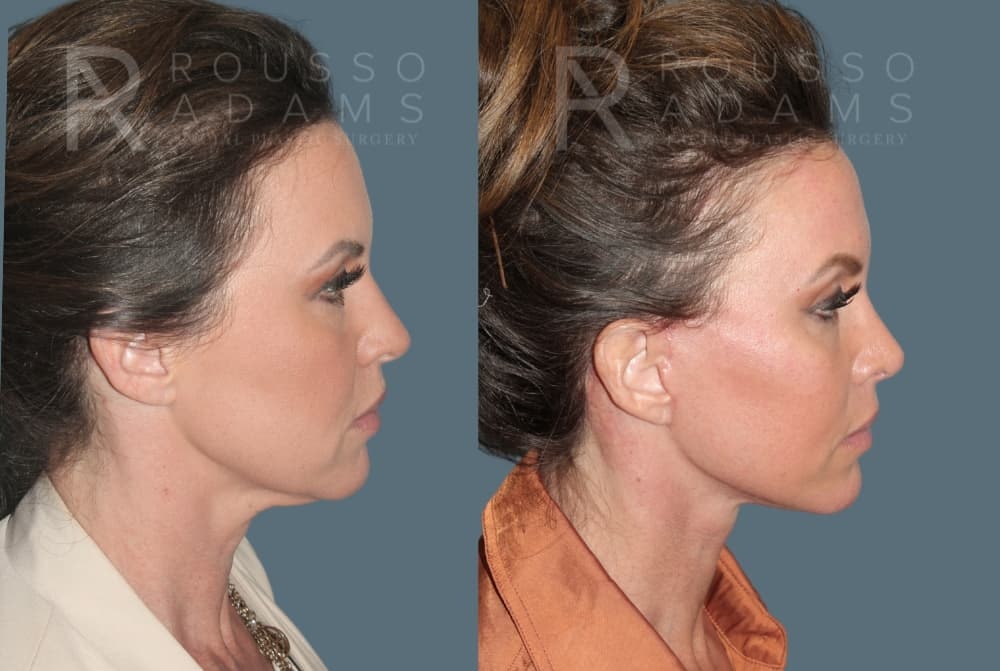 Deep Plane Facelift Before & After Gallery - Patient 422353 - Image 4