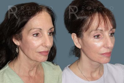 Deep Plane Facelift Before & After Gallery - Patient 212388 - Image 1