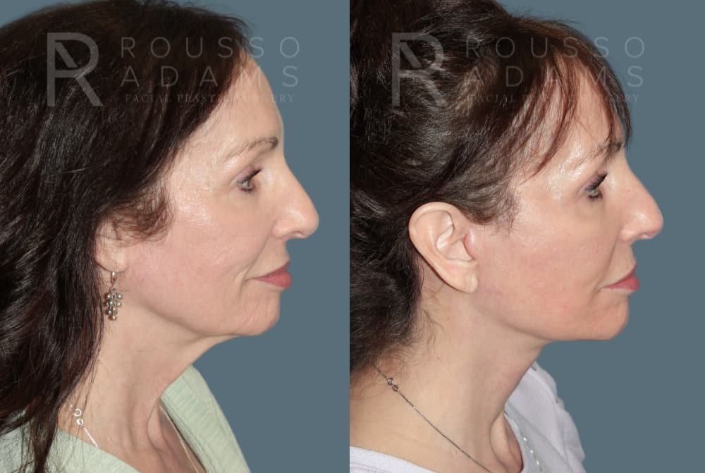 Deep Plane Facelift Before & After Gallery - Patient 212388 - Image 2